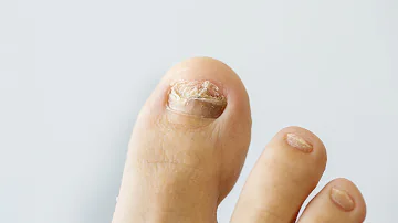 ¿Por qué el esmalte de uñas daña las uñas de mis pies?