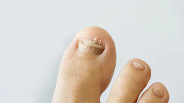 ¿Cuál es el medicamento de venta libre más eficaz contra los hongos en las uñas de los pies?