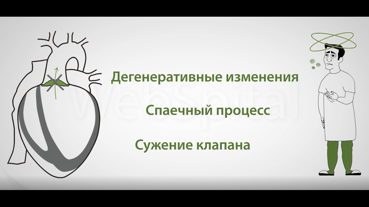 Стеноз аортального клапана лечение