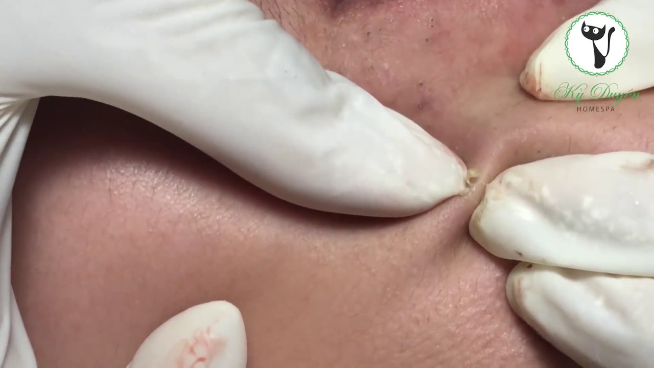 Xử lý vật thể lạ trên vành môi to đùng | Gà Spa - youtube