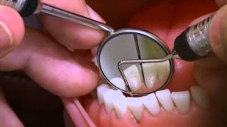 Probe Lingual Mandibular Anteriors