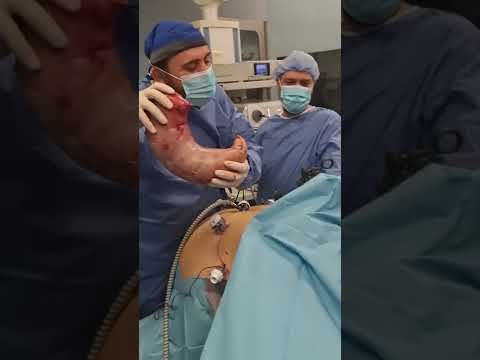 تكميم المعدة البنج النصفي الدكتور محمد الزيتاوي