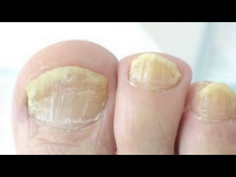 Не Кормите Аптеки! Грибок Ногтей Боится как Огня Обычного...Лечение