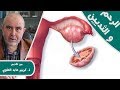 وصفات طبيعية لعلاج اكياس الرحم و الثدي ومشاكل الدورة الشهرية مع الدكتور كريم عابد العلوي