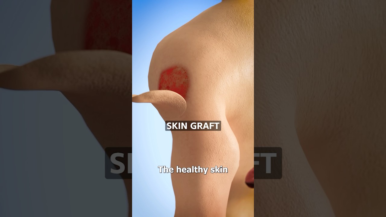 How Skin Grafts Work 😷 Surgeon Reacts
