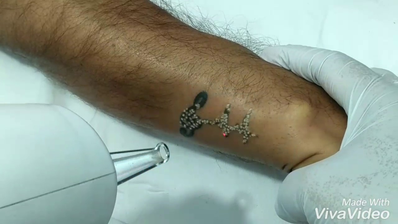 Laser tattoo removal at Delight Clinic 