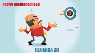 Poorly positioned DBS leads: how to program Profile