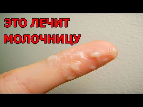 Как лечить молочницу у женщин в домашних условиях | Эффективное лечение молочницы