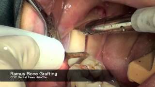 ramus bone grafting for implant site developement Resimi