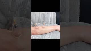 Learn #cupping for free #physiotherapist #manualtherapy #massage