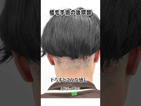 【閲覧注意】植毛手術の後頭部はこうなっています。