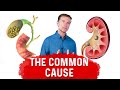 Gallstones vs Kidney Stones: A Common Cause