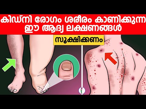 കിഡ്‌നി രോഗം ശരീരം കാണിക്കുന്ന ഈ ആദ്യ ലക്ഷണങ്ങൾ സൂക്ഷിക്കണം | Kidney Malayalam