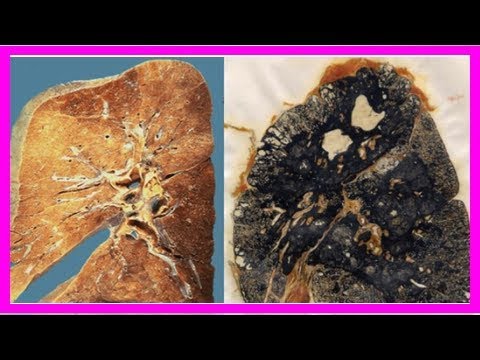 Black Lung Disease Comes Storming Back in Coal Country