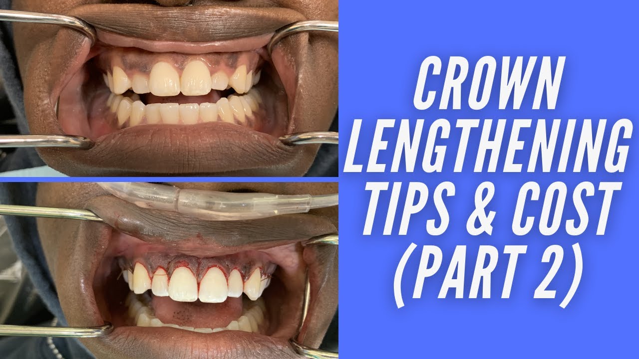 CROWN LENGTHENING TIPS & COST (PART 2) YouTube
