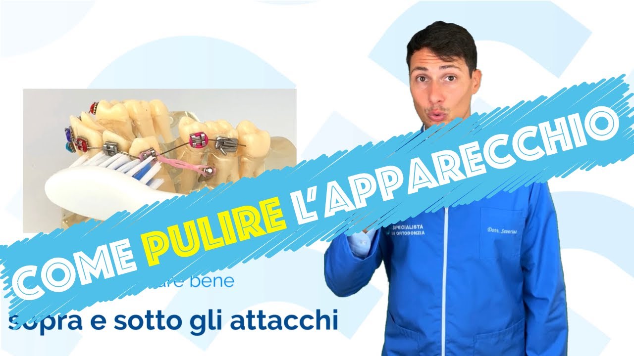Come lavare i denti con l'apparecchio ortodontico (brackets)