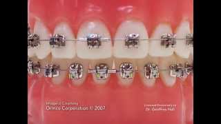 Advanced Orthodontics - Self Ligating Brackets