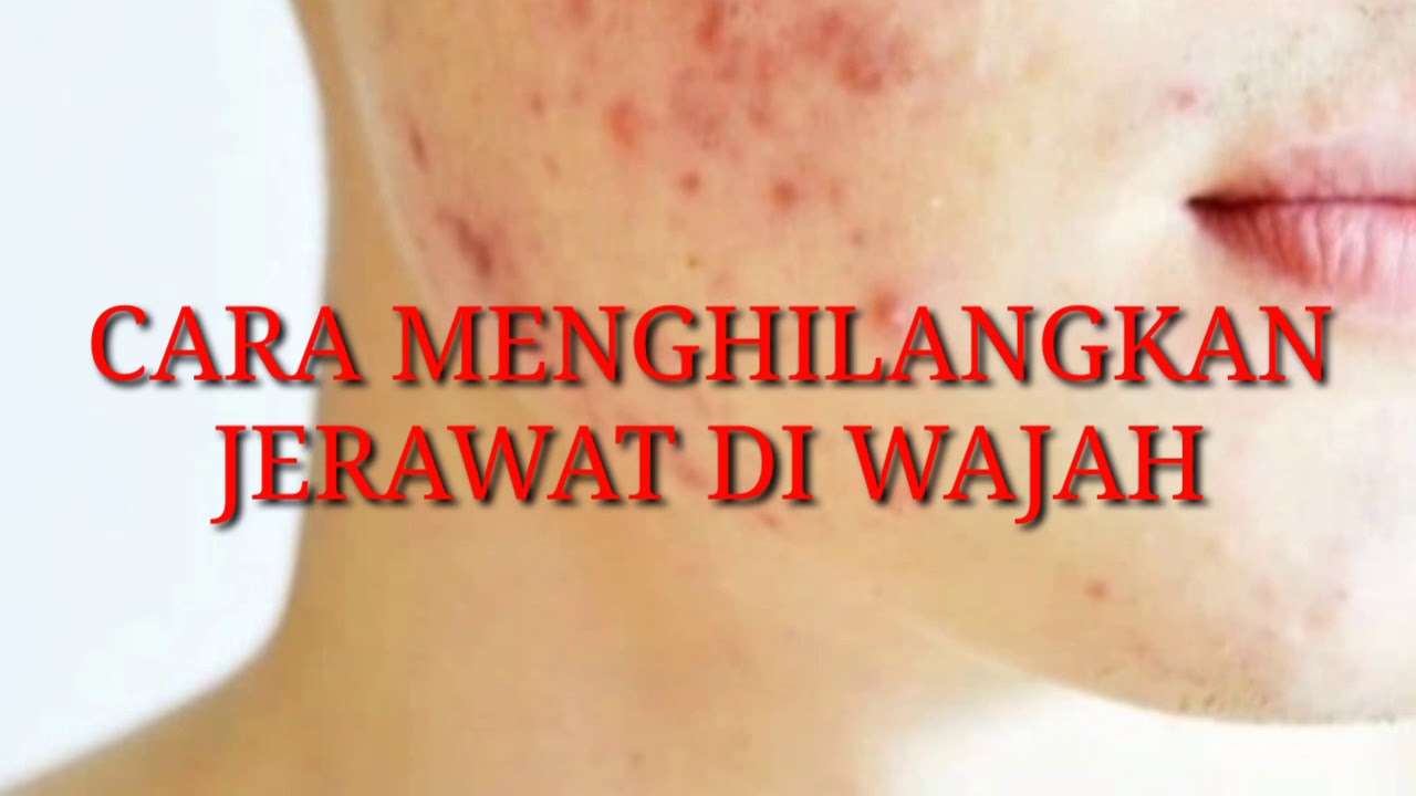 Cara menghilangkan jerawat - Bruntusan - YouTube
