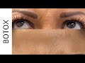 BOTOX Results in Houston at Body by Ravi Plastic Surgery & Aesthetics