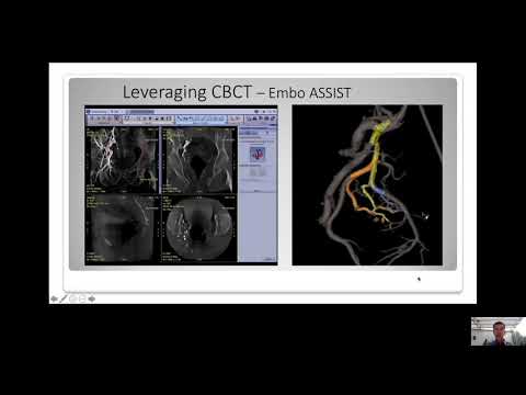 CIRSE 2020 - What are the PAE intraprocedural planning challenges & how to identify the vessel?