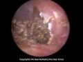 223 - Difficult Endoscopic Microsuction Ear Wax Removal Procedure - Mr Neel Raithatha (THC)