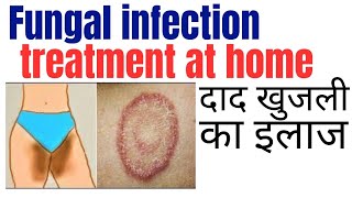 Fungal infection treatment at home | Khujli ki medicine | Daad ki best medicine