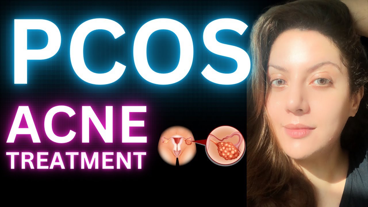 How To Get Rid Of Pcos Cystic Acne Hormonal Acne Treatment YouTube