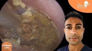 1,079 - Crusted Ear Wax Removal off Eardrum
