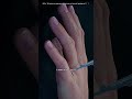 How Finger Fracture Surgery Is Performed (3D Animation)#fingerfracture#medical3danimation
