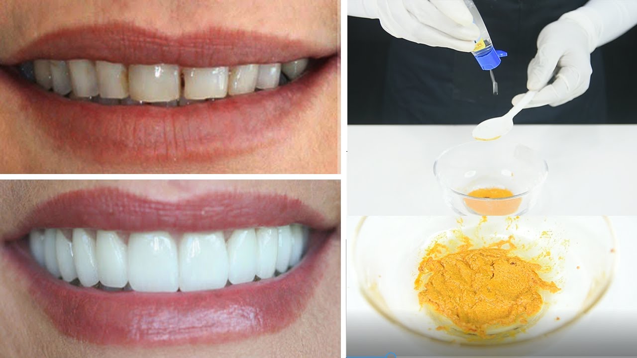 A Dentist Friend Told Me How Whiten Your Yellow Teeth in less than 2 Minutes Homemade Health