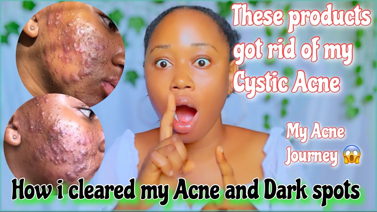 PRODUCTS THAT GOT RID OF MY ACNE AND HYPERPIGMENTATION| Acne treatment ...
