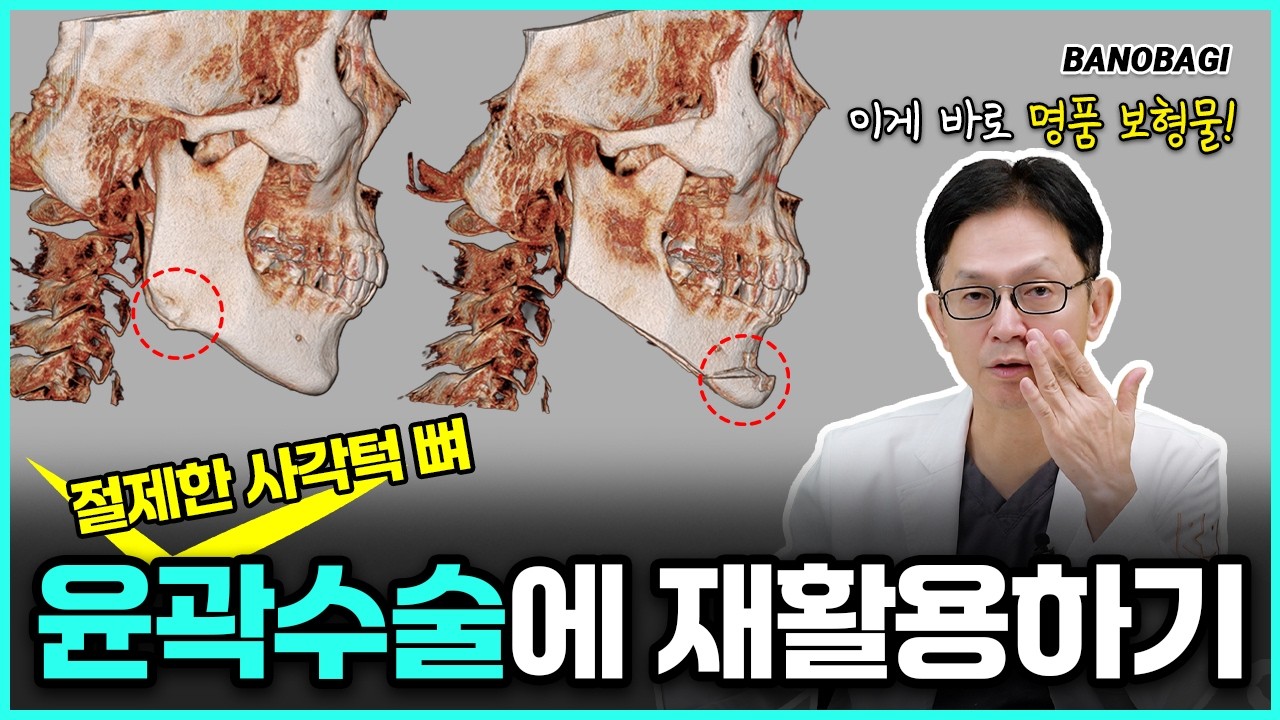 사각턱 뼈의 변신💀명품 보형물로 태어난 사각턱 뼈를 활용한 윤곽수술 전후 비교❤️