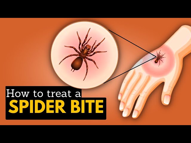 Treatment for Spider Bites