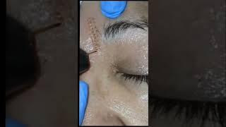 Eliminación de Líneas de expresión con Fibroblast desde s/150 atención a domicilio Lima 🇵🇪