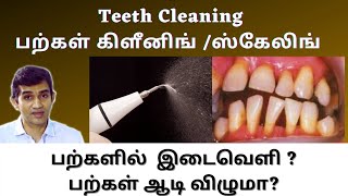 Teeth Cleaning | பற்கள் கிளீனிங் ஸ்கேலிங் செய்வதால் பற்களின் இடைவெளி அதிகமாகுமா?/ பற்கள் ஆடி விழுமா?