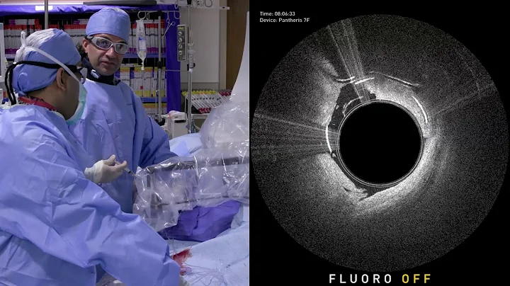 CTO Crossing and Atherectomy Case Study with Ocelot and Pantheris devices - Dr. Jaafer Golzar