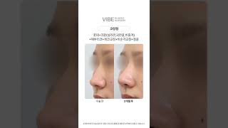 코성형 + 콧대 + 코끝(실리콘, 귀연골, 비중격) + 매부리코 + 복코교정 + 비순각교정 + 절골 #shorts
