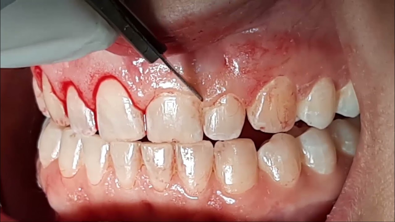 Treating Excessive Gingival Display with Crown Lengthening Dr. Hussam