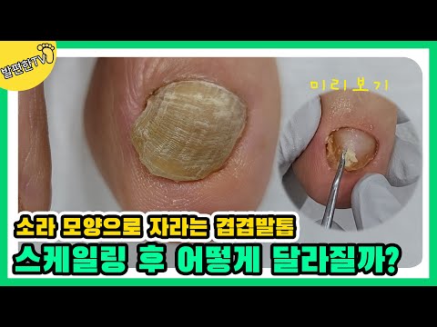 [ENG SUB] 소라 모양 처럼 줄이 생기고 휘어지며 두껍게 자란 발톱.. 어떻게 예쁜 발톱으로 길러낼 수 있을까!?