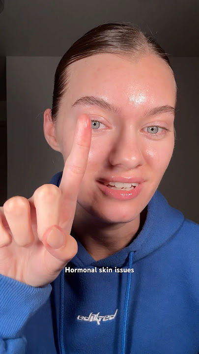 Which side are you on?🙈🥹 #acne #skincare #acnetreatment #hormonalacne