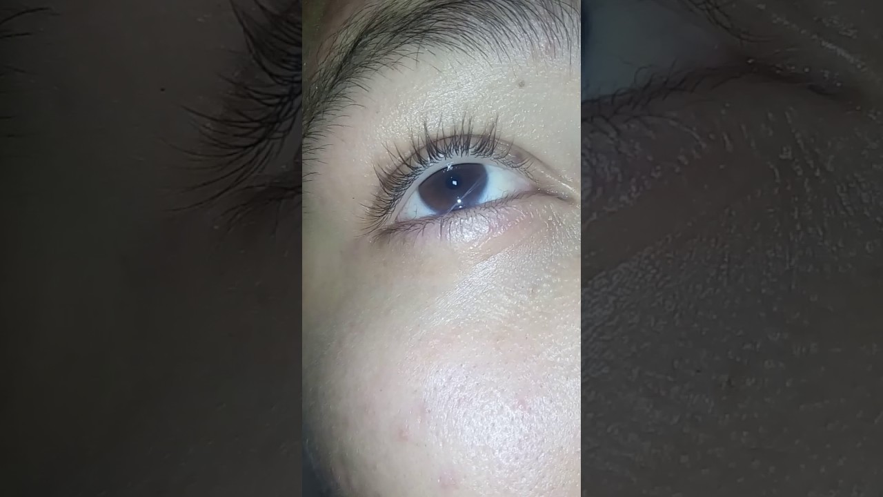 Quanto Tempo Depois De Dilatar A Pupila Pode Dirigir