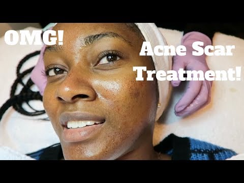 My Dermatology Acne Scar Treatment! | Microneedling Experience