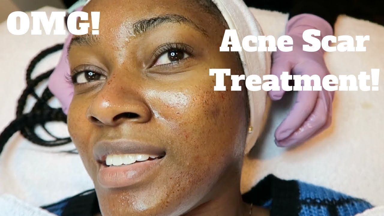 My Dermatology Acne Scar Treatment! Microneedling Experience YouTube