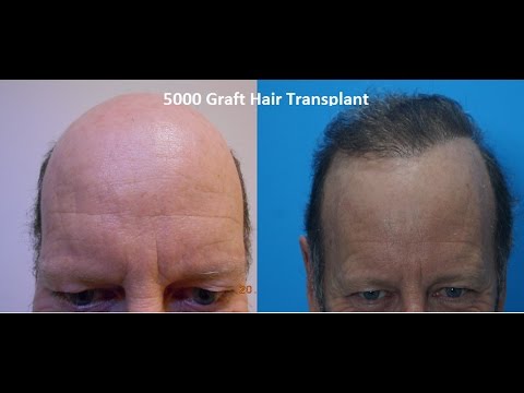 5000 Graft Hair Transplant In India Patient From New Zealand By Dr Kapil Dua By Ak