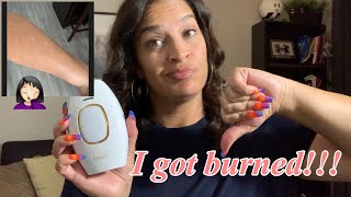 My Kenzzi burned my arms | my scars | Vitamin E oil | I got burned | Kenzzi review | Kenzzi update