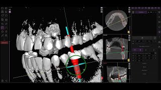 Download Lagu Step-by-Step Implant Placement. Library Implant. MP3