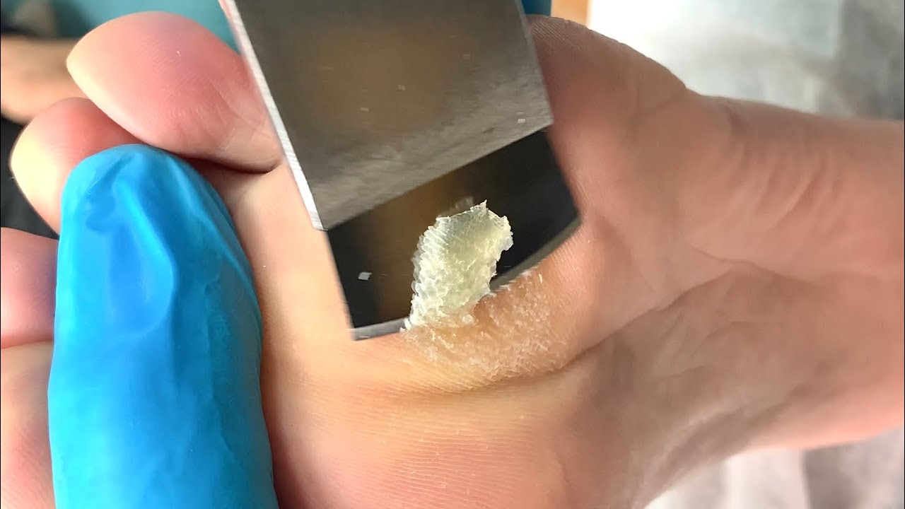 Callus removal from feet&Foot scraping dead skin【Xiao Yan pedicure】