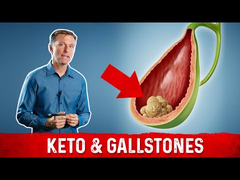 Doesn&#39;t Keto Cause Gallstones Eating All That Fat?