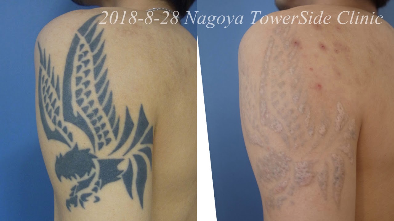 レーザータトゥー除去 (肥厚性瘢痕)  Laser Tattoo Removal (Hypertrophic scar)