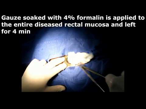 Technically Standardized Approach for Laparoscopic Left Hemicolectomy. 